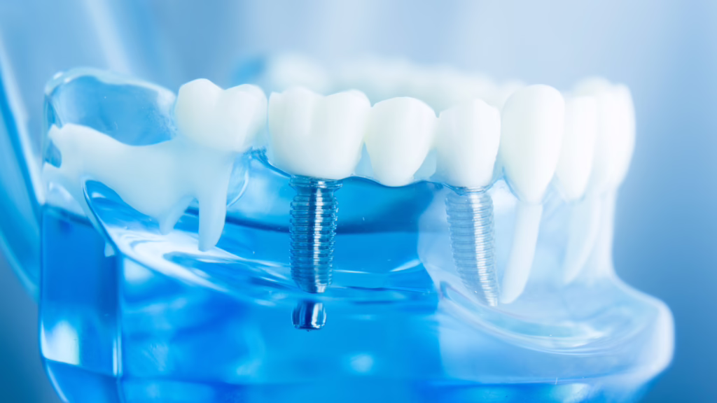 Can You Get a Dental Implant Years After Losing a Tooth?