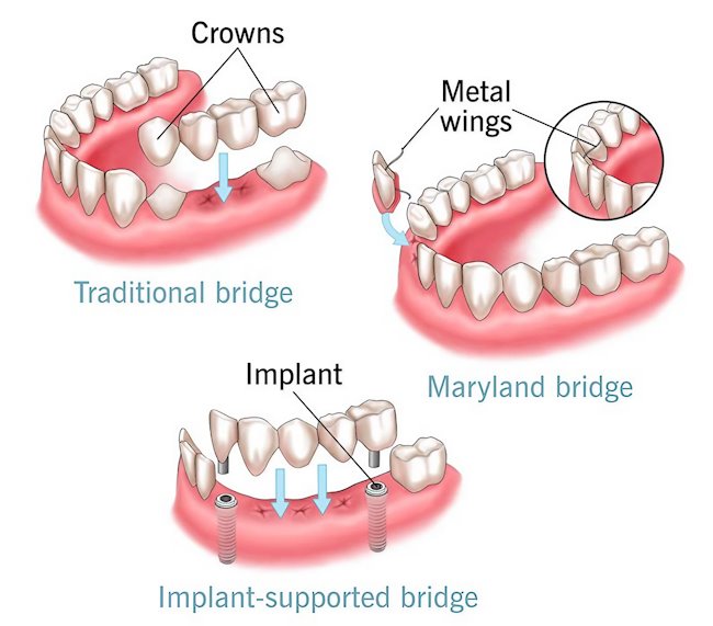 dental bridge la mesa